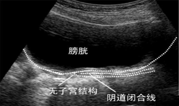 “石女”做阴道B超图像