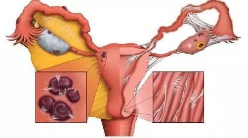 宫腔粘连是什么